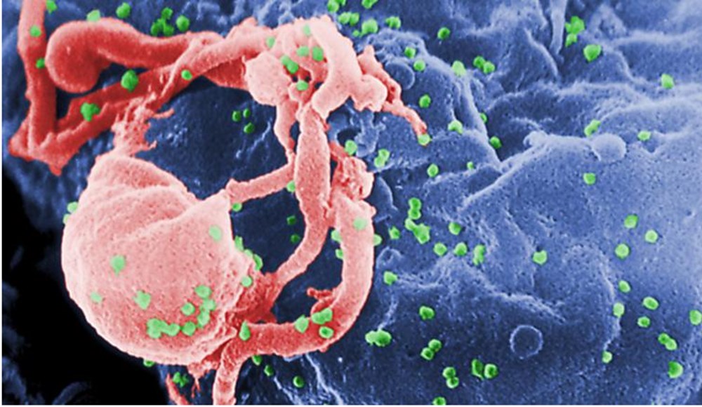 Bilim dünyasını şoke eden olay: AIDS hastası kadın hiçbir tedavi görmeden iyileşti - 6