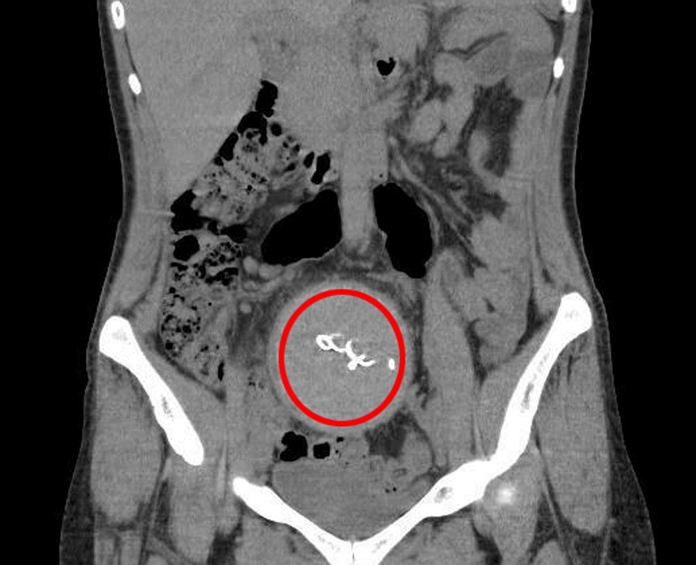 Doğumda unutuldu, iki yıl sonra ortaya çıktı: Gazlı bez ihmaline soruşturma - 5