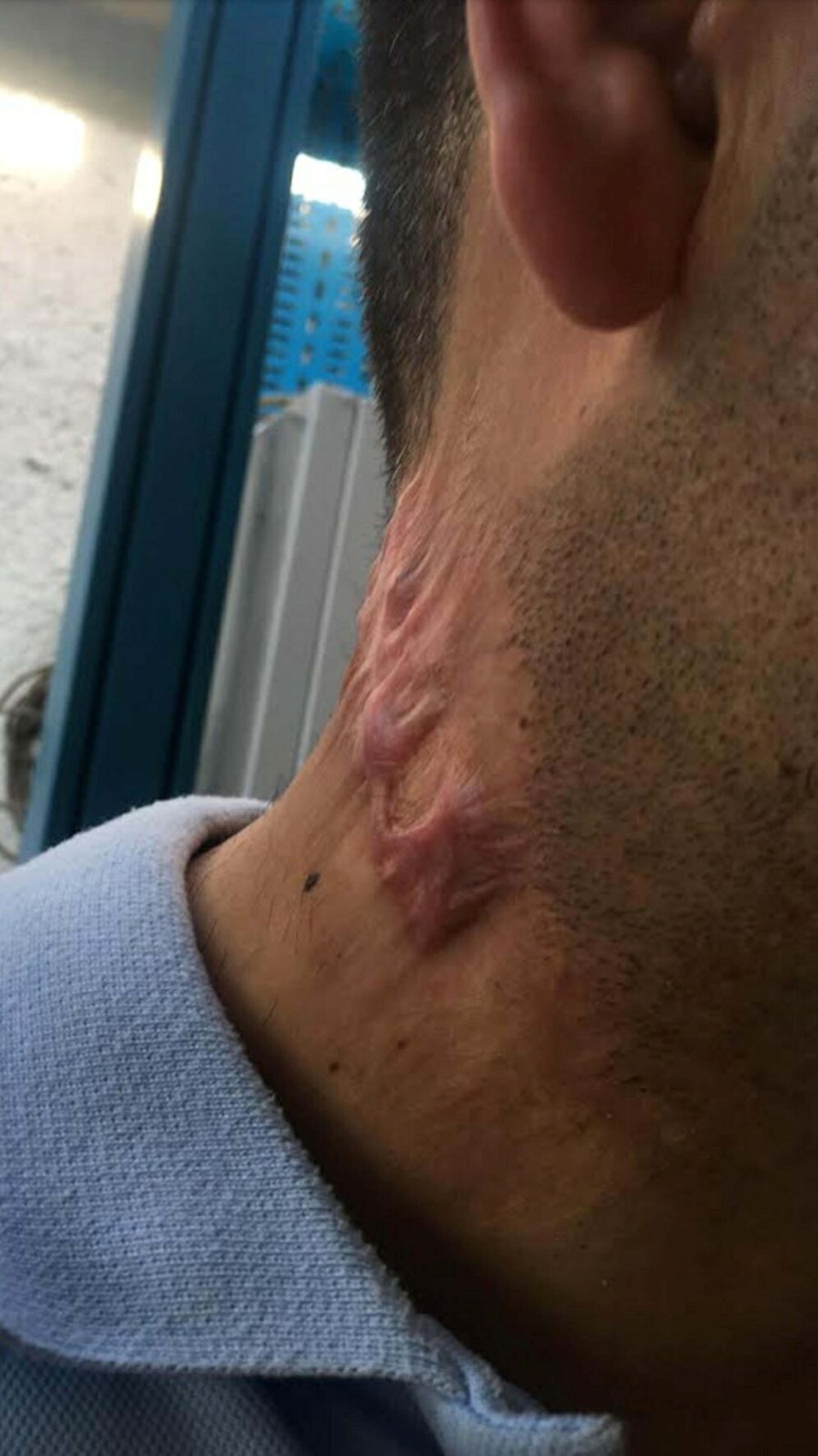 Lazer hayatını kararttı: Tedavi 30 yıl geriye götürdü - 2