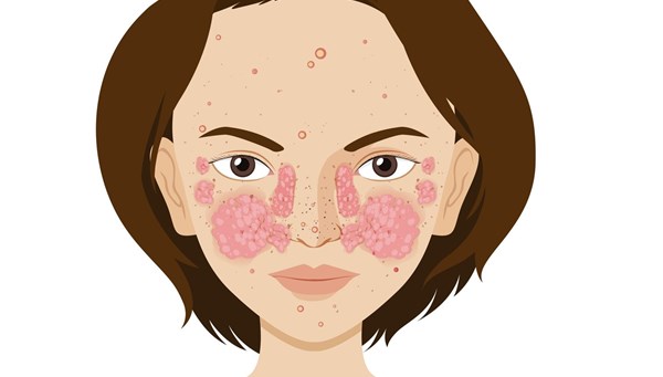 Kelebek hastalığı (lupus) nedir, belirtileri nelerdir? Kelebek hastalığı nasıl tedavi edilir?