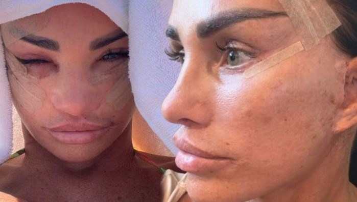 Defalarca yüzünü gerdiren Katie Price'ın son haline yorum yağdı!