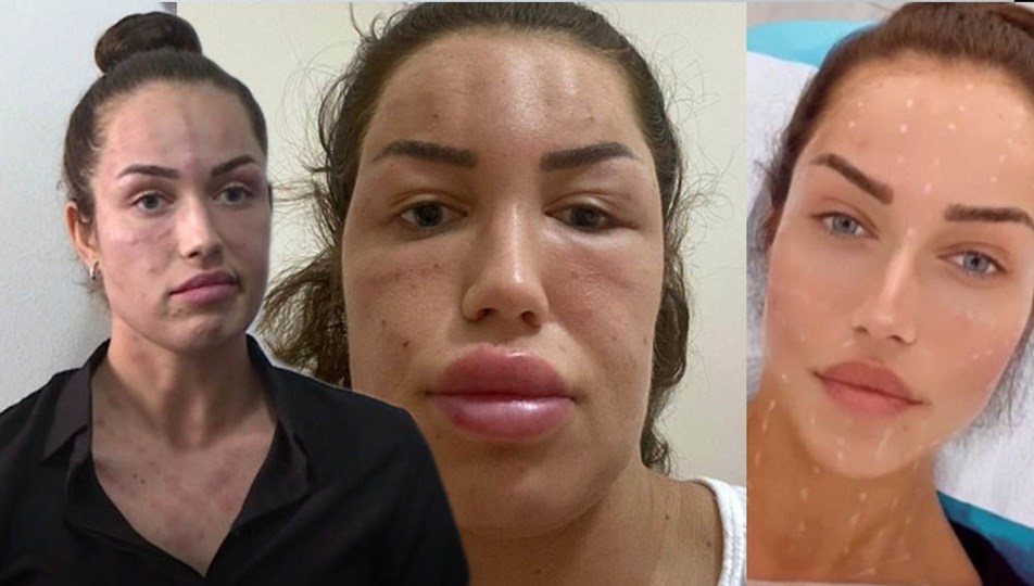 İzmir�de �gençlik aşısı� adı altında cildine işlem yapılan kadından suç