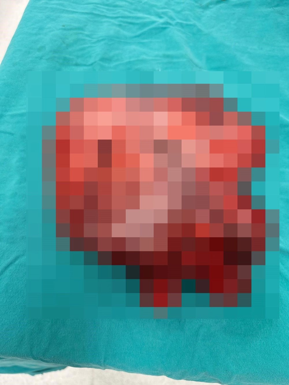 3 belirtiyle hastaneye gitti, şoke oldu: 43 yaşındaki kadının karnından 35 santim boyutunda çıktı - 3