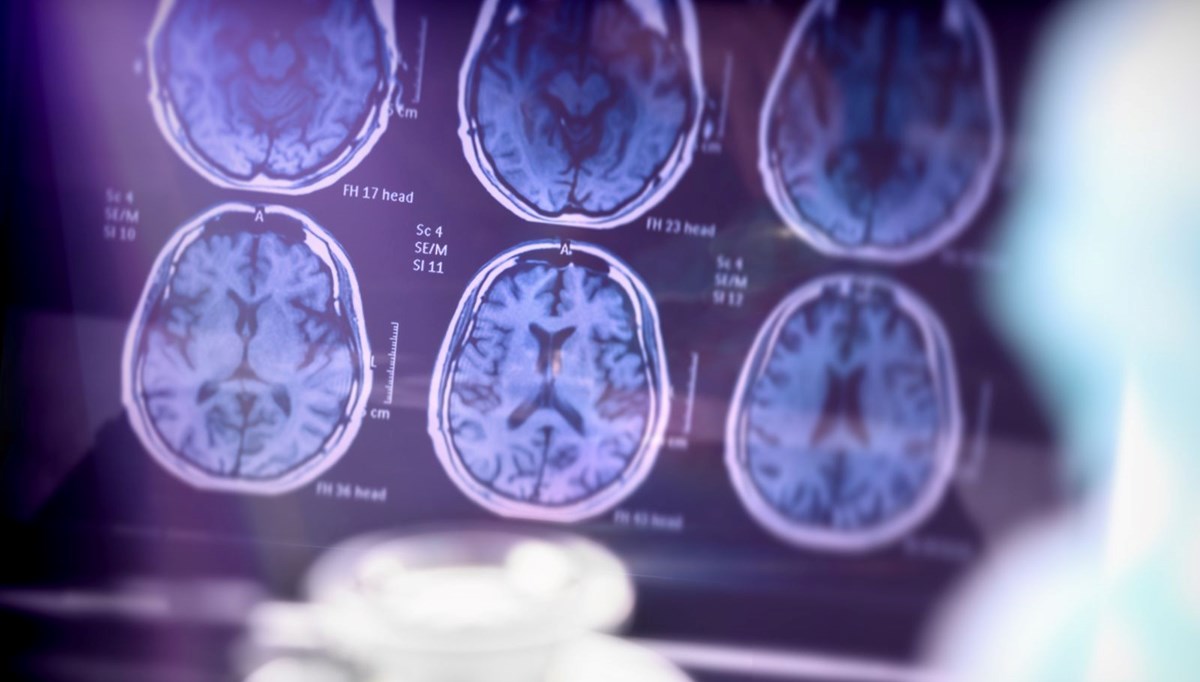 Uçuk virüsü beyni nasıl tehdit ediyor? Alzheimer'ı tetikliyor mu? Uçuk virüsü beyni nasıl tehdit ediyor? Alzheimer'ı tetikliyor mu?
