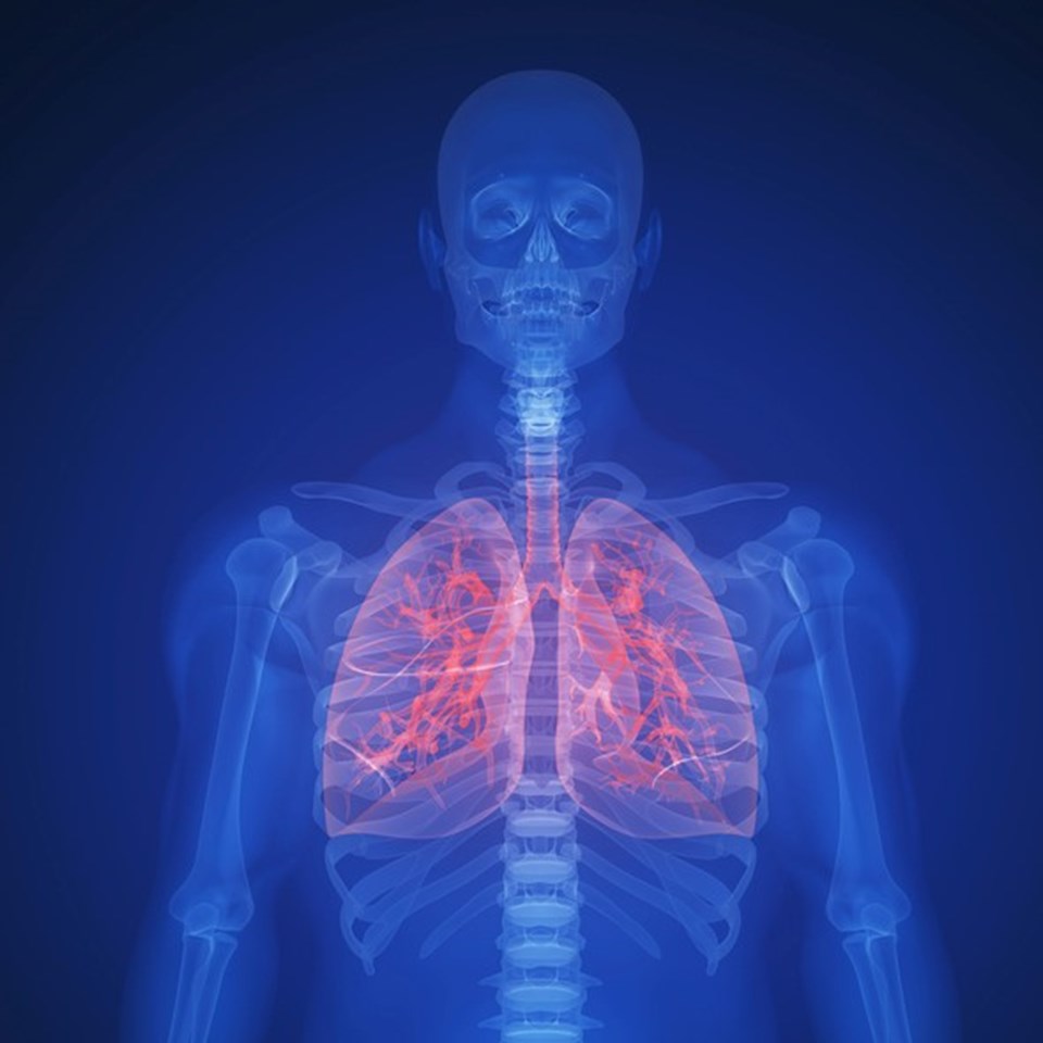 Akciğer kanserinde multidisipliner yaklaşım önemli - 1