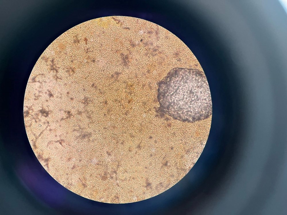 Doktorları şaşırtan görüntü: Tenyalar organlarını delik deşik etti - 3