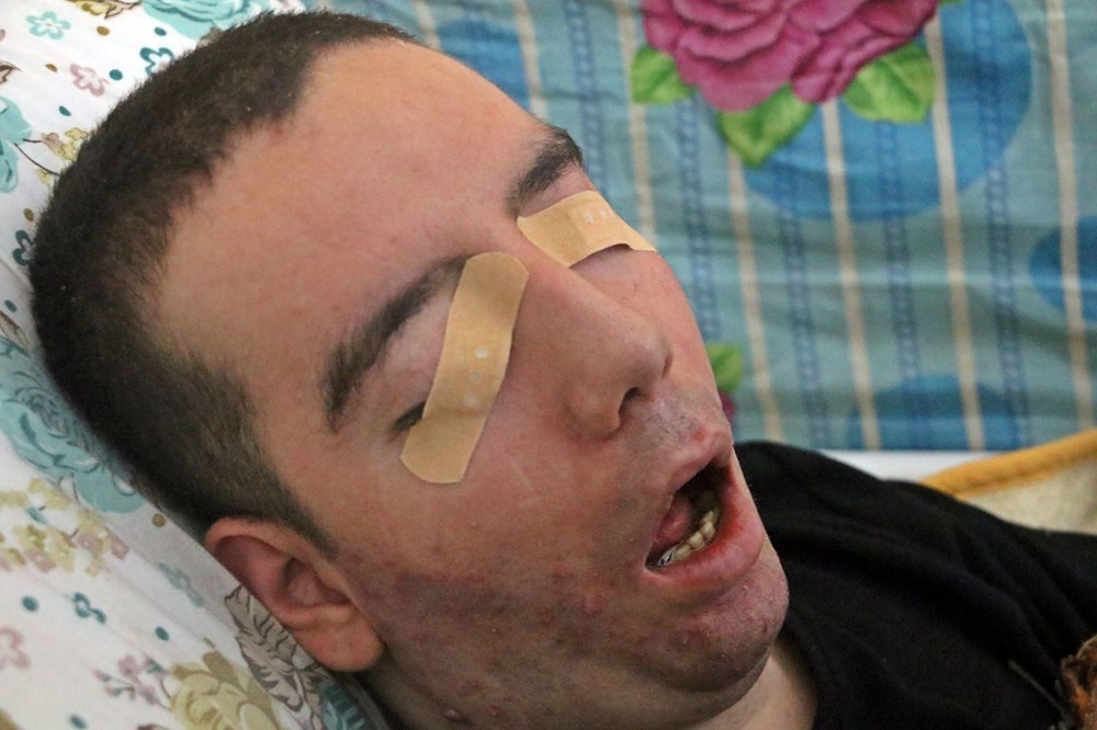 13 yıl gözlerini hiç kapatamadı, sesi kısık kaldı: SSPE hastası gencin acı öyküsü 74 X0M xJQ U TIqNslD cMg