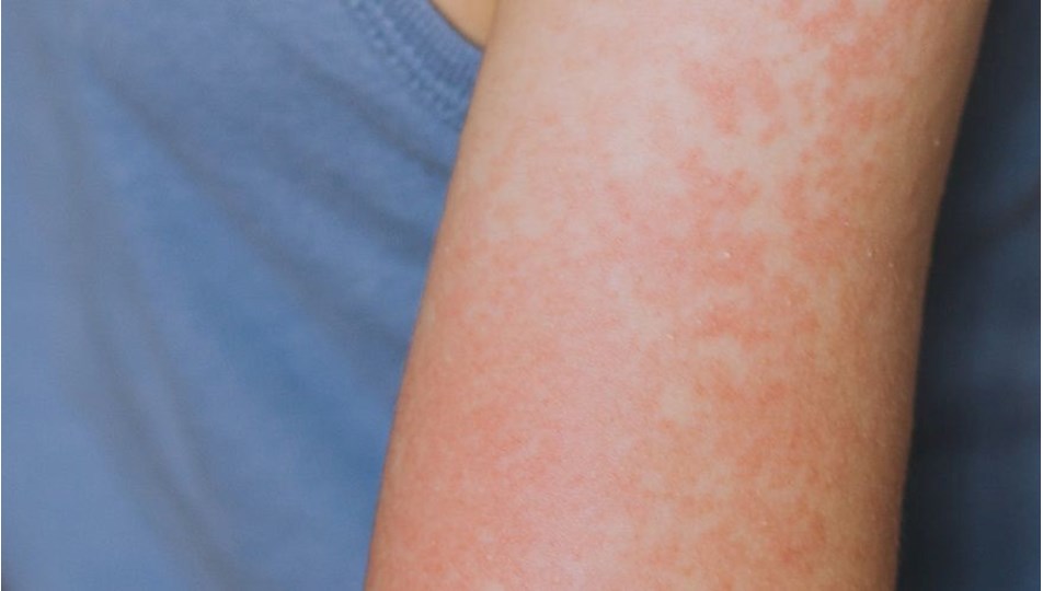 Kızamık vakaları artıyor: Teksas'ta 48 vaka tespit edildi