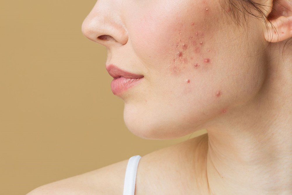 Roaccutane onlarca gencin intiharına neden oldu: Türkiye'de de kullanılan ilaç için kritik uyarı - 7