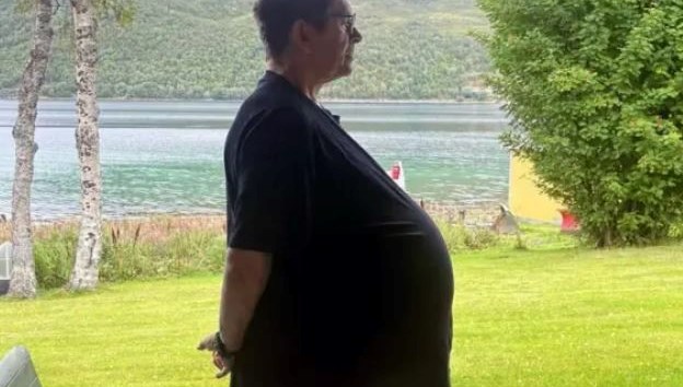 Zayıflamak için doktor doktor gezen adamın karnından çıkan şey tıp dünyasını bile şaşkına çevirdi!