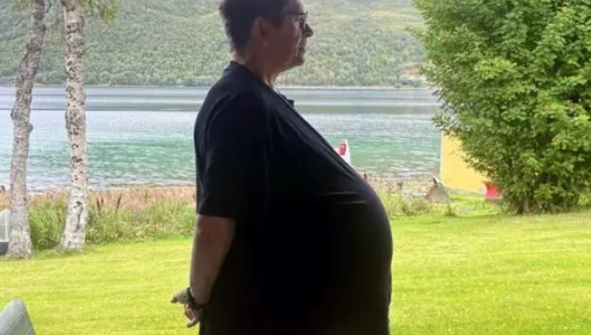 Zayıflamak için doktor doktor gezen adamın karnından çıkan şey tıp dünyasını bile şaşkına çevirdi!