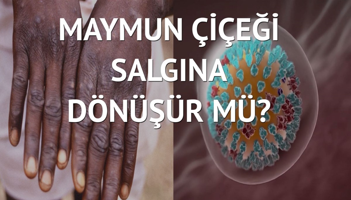 Türkiye’de 5 maymun çiçeği vakası