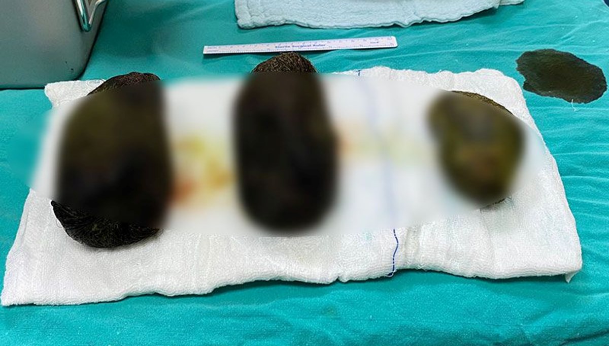 Karın ağrısıyla gitti midesinden 2 kilo saç çıktı Karın ağrısıyla gitti midesinden 2 kilo saç çıktı