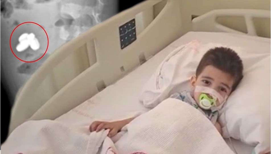 Pil ve mıknatıs yutan çocuğun bağırsakları yandı