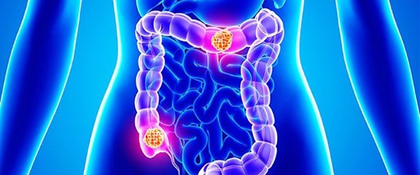 Bağırsakta polip oluşumunun 8 nedeni
