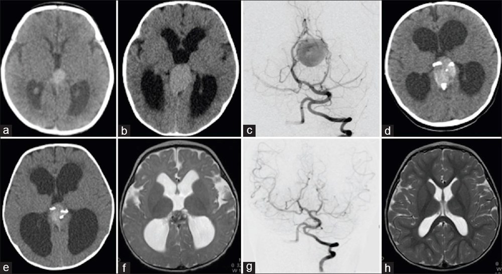 Dünyada ilk kez: Ölümcül genetik bozukluğu olan bebeğe rahimdeyken beyin ameliyatı yapıldı - 2