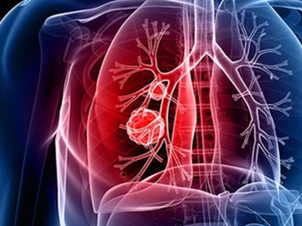 akciger kanserinin 7 belirtisine dikkat