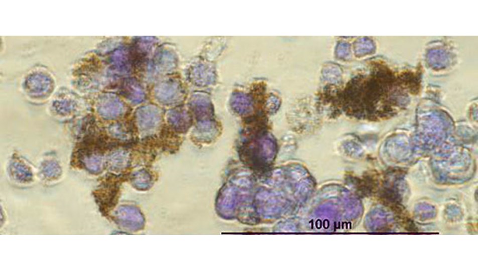 Nanoteknolojiyle kanserde erken teşhis