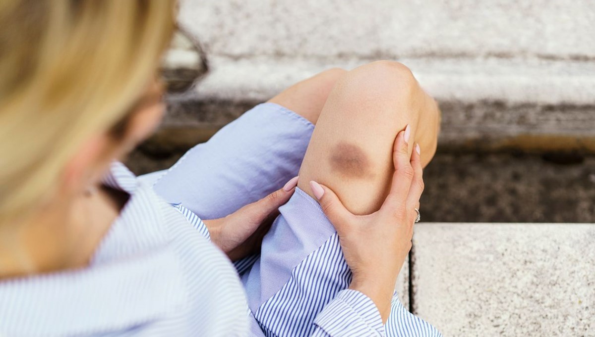 Vücuttaki açıklanamayan morluklar neyin belirtisi? Ölümcül hastalığın habercisi olabilir