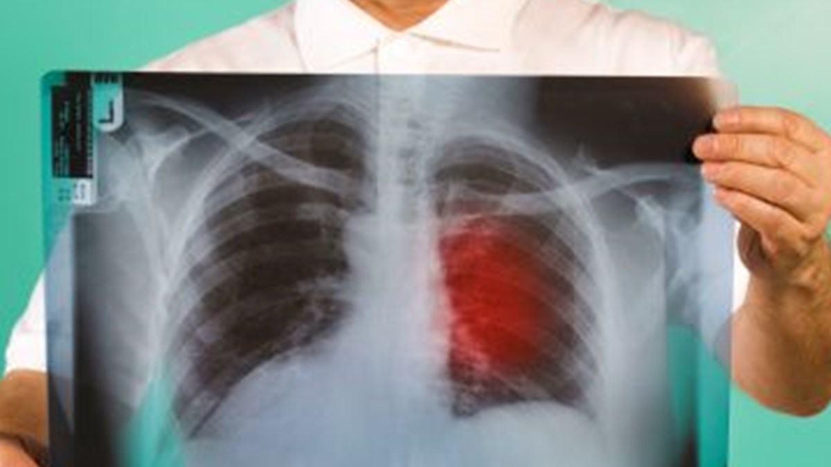 akciger kanseri erken tani ile tedavi edilebilir