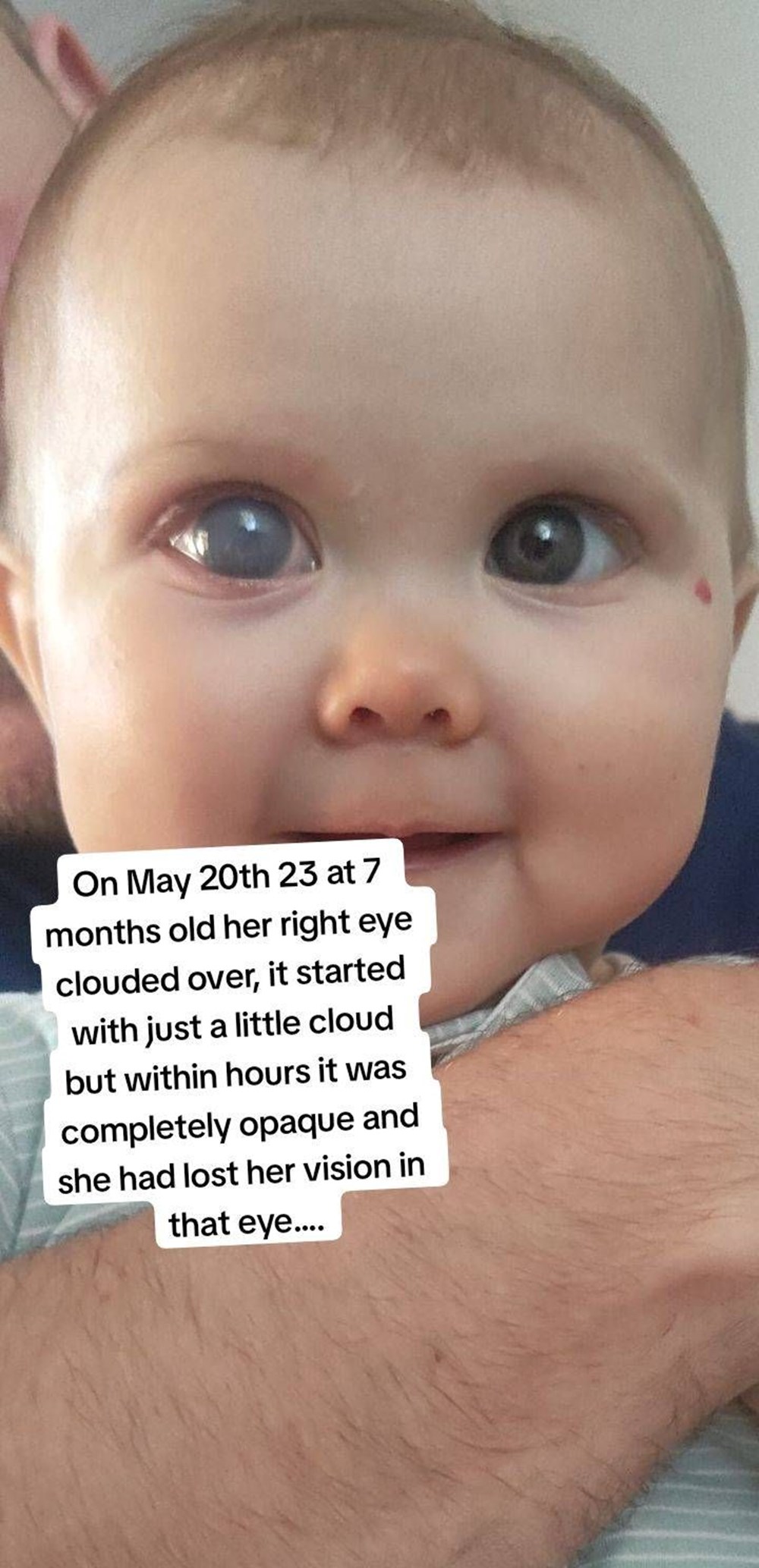 Dünyada nadir görülen hastalık: 21 aylık bebek kan ağlıyor! - 3