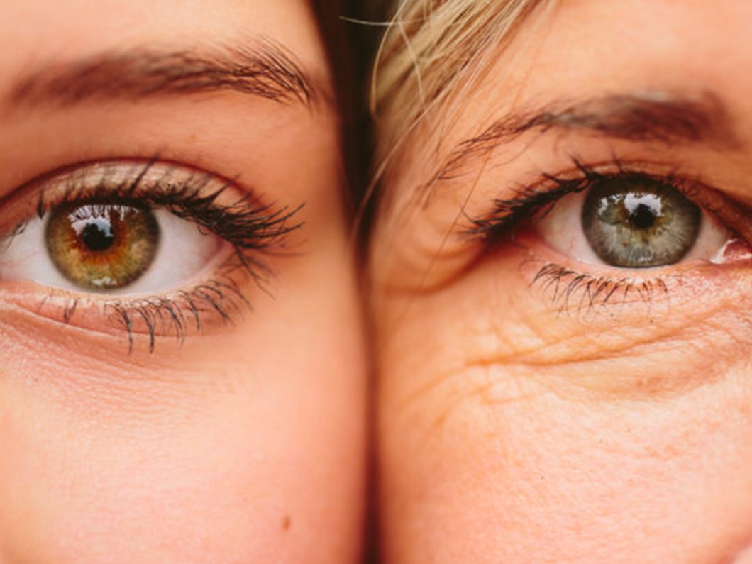 goz altindaki sislikler neden olur nasil engellenir ntv