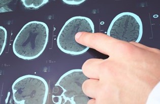 epilepsi nobeti ne zaman beyin