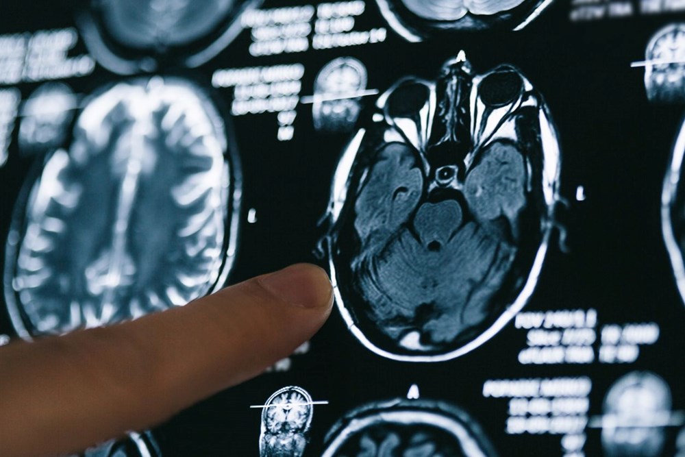 Alzheimer hastaları için gerçek bir tedavi sunan ilk ilaç: Lecanemab nedir? Lecanemab'ın yan etkileri nelerdir? - 6