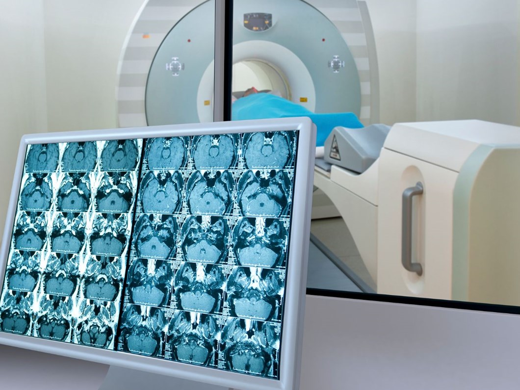 Kanser Taramasi Ile 79 Bin Erken Teshis Saglik Haberleri Ntv