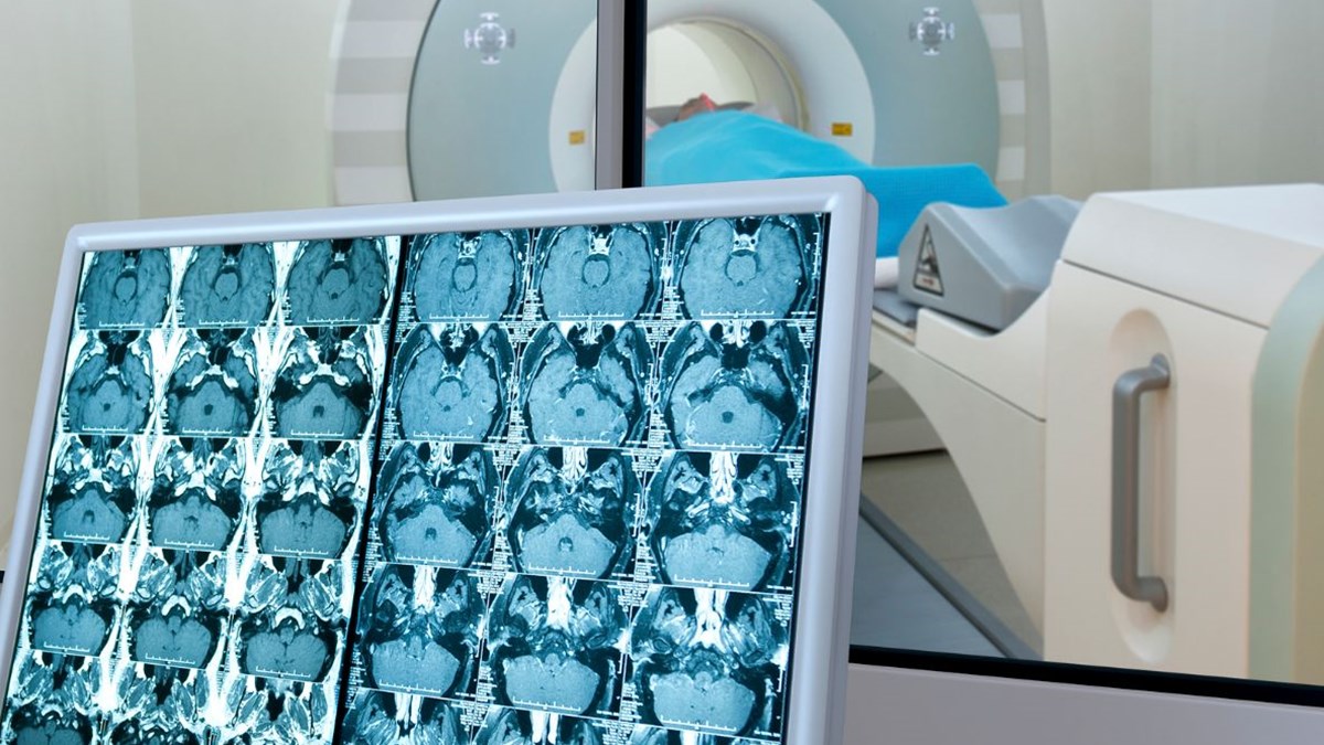 Kanser Taramasi Ile 79 Bin Erken Teshis Saglik Haberleri Ntv