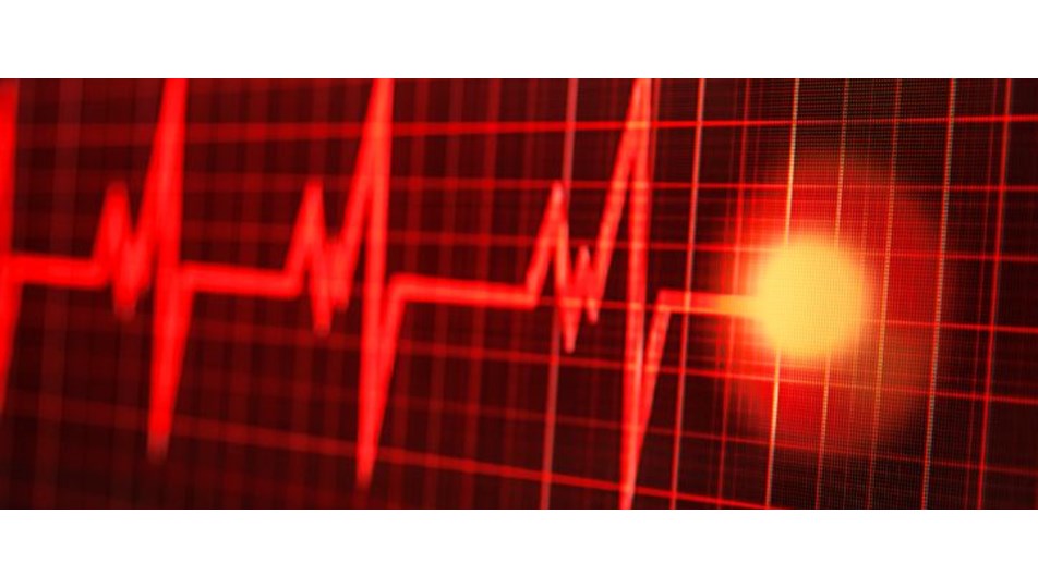 Atriyal Fibrilasyon Ne Zaman Tehlikeli Olur Kalpte Ritim Bozukluguna Dikkat Saglik Haberleri Ntv