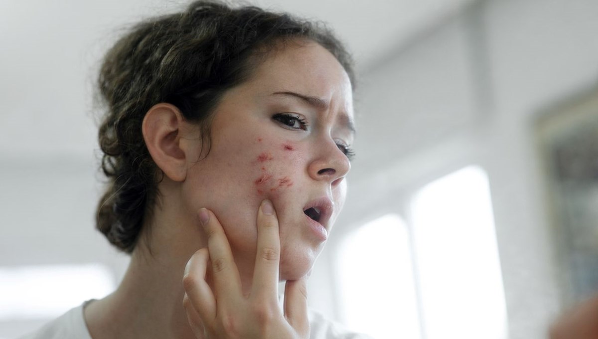 Sivilce oluşumunu tetikleyen 4 besin: Ciltte iltihaba yol açıyor