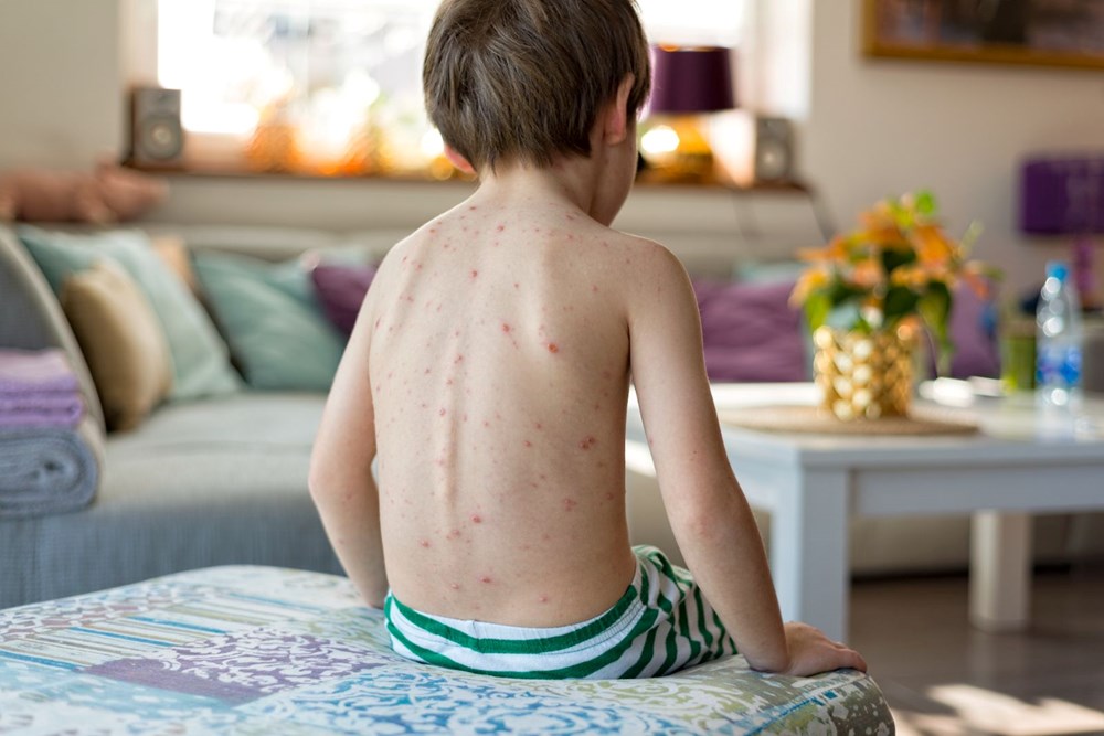 Yeni salgın alarmı: Domates gribi (Domates gribi belirtileri neler?, bulaşıcı mı? tedavisi var mı?) - 1