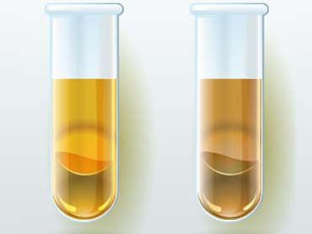 idrar rengi kanser veya enfeksiyon habercisi de olabilir saglik haberleri ntv