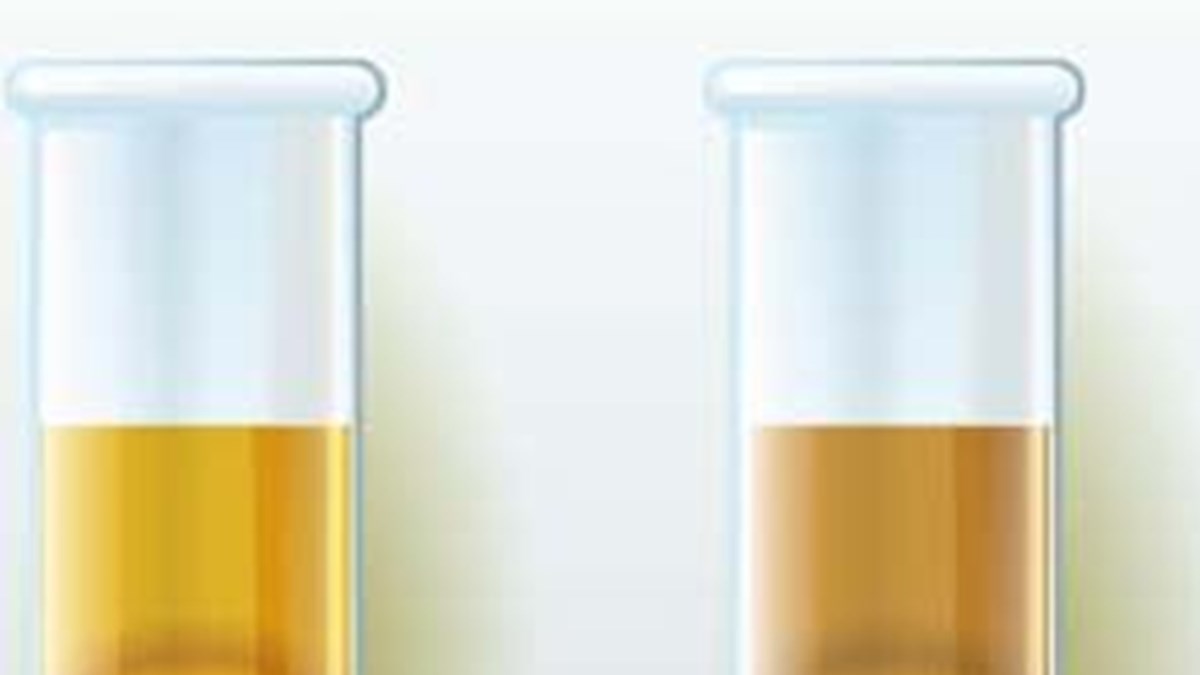 idrar rengi kanser veya enfeksiyon