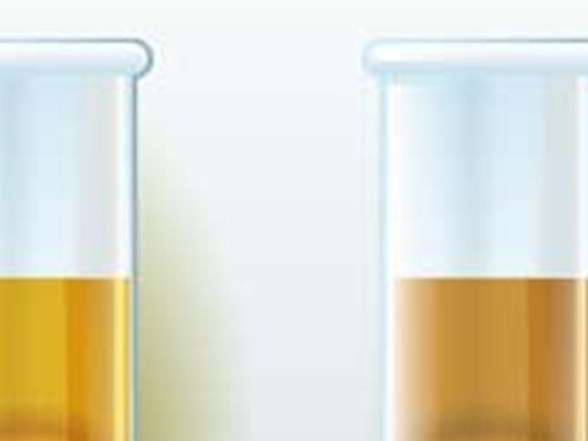 idrar rengi kanser veya enfeksiyon