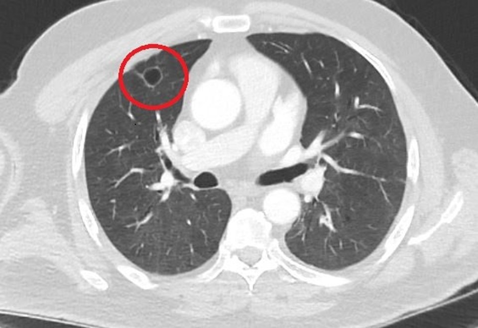 Dünya tıp literatüründe bir ilk: Covid-19, akciğer kanserini taklit etti - 1