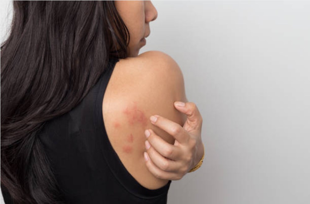 Zona hastalığı nedir? Cilt hastalıkları nelerdir? Cilt hastalıklarının belirtileri nelerdir? (Egzama, ürtiker, sedef, zona) - 10