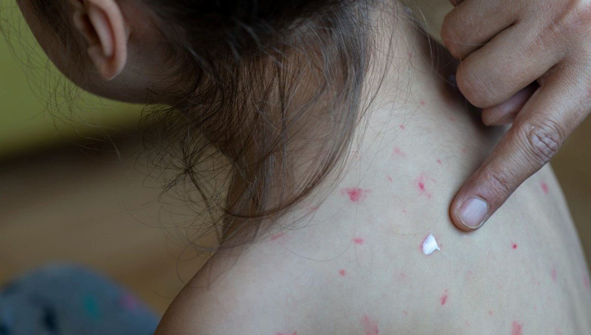 Uzmanlar uyardı: Yaygın hastalık körlüğe neden olabilir, belirtileri soğuk algınlığıyla karıştırılıyor