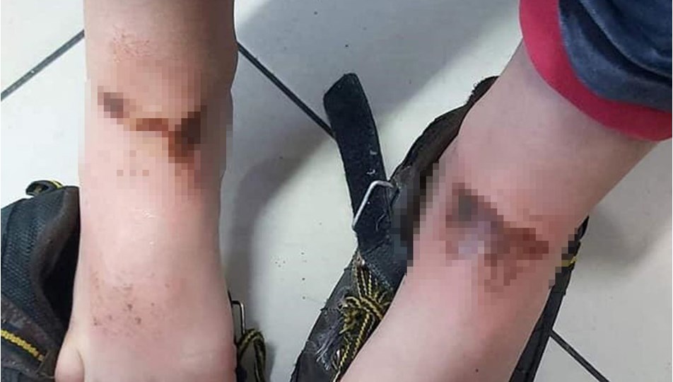 Karla oynarken vücutlarında yanık oluşan 2 çocuğa doku nakli yapılacak