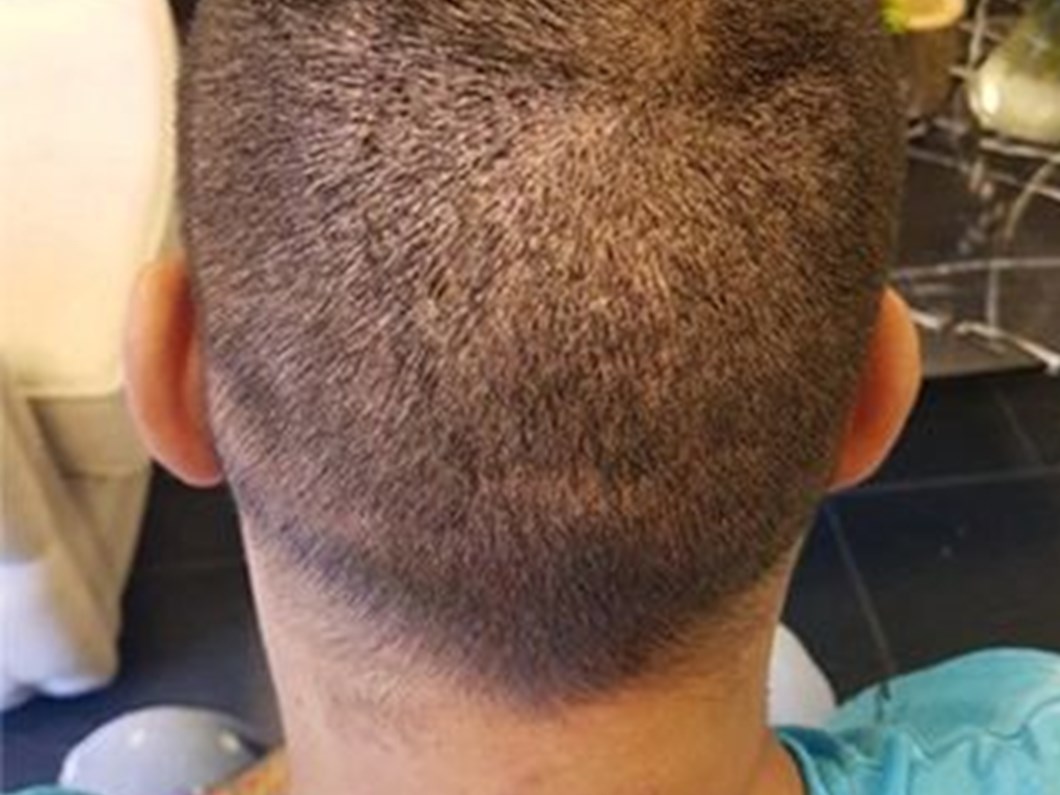 Istanbul Da Sac Ekimi Olume Goturdu Ntv Haber Ofisi