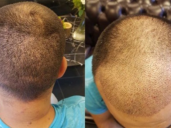 Istanbul Da Sac Ekimi Olume Goturdu Ntv