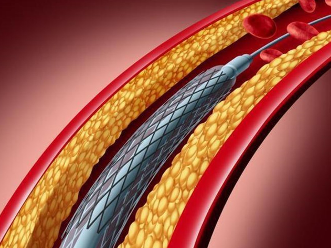 Tip Dunyasinda Tartisma Eriyen Kalp Stenti Tehlikeli Mi Saglik Haberleri Ntv
