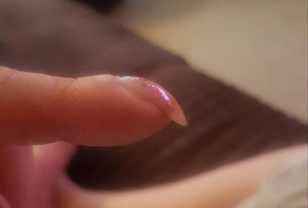 Akciğer kanseri riski için basit parmak testi: Schamroth Testi nasıl yapılır? - 9