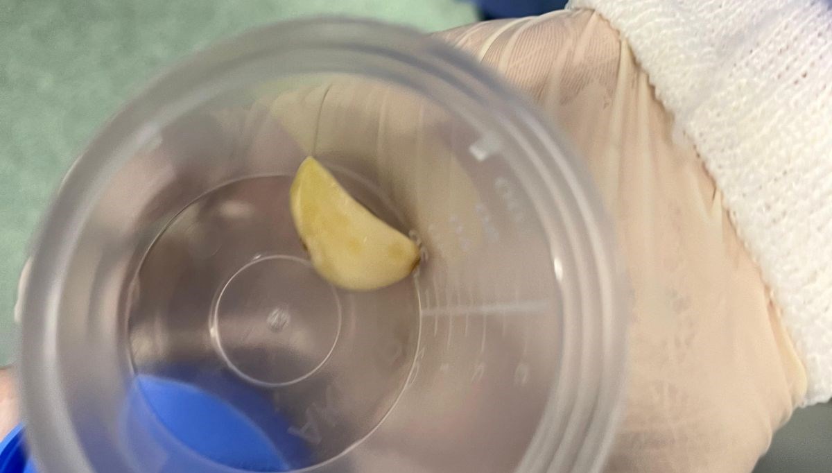 Yaşlı adamın akciğerine sarımsak kaçtı,