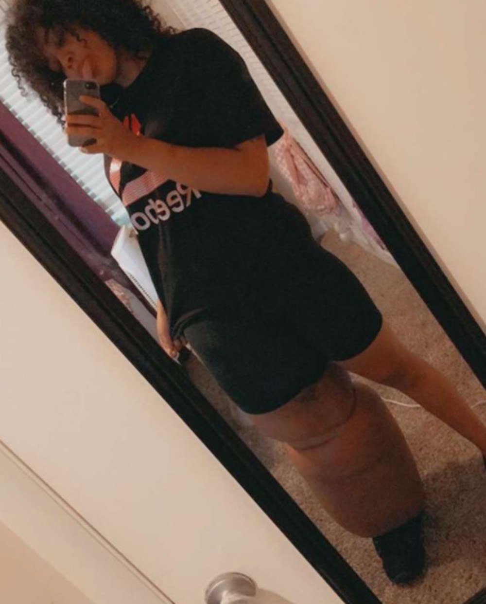 Doğuştan lenfödemili (fil hastalığı) Mahogany Geter acımasız eleştirilere rağmen görünüşüyle barışık yaşıyor - 3