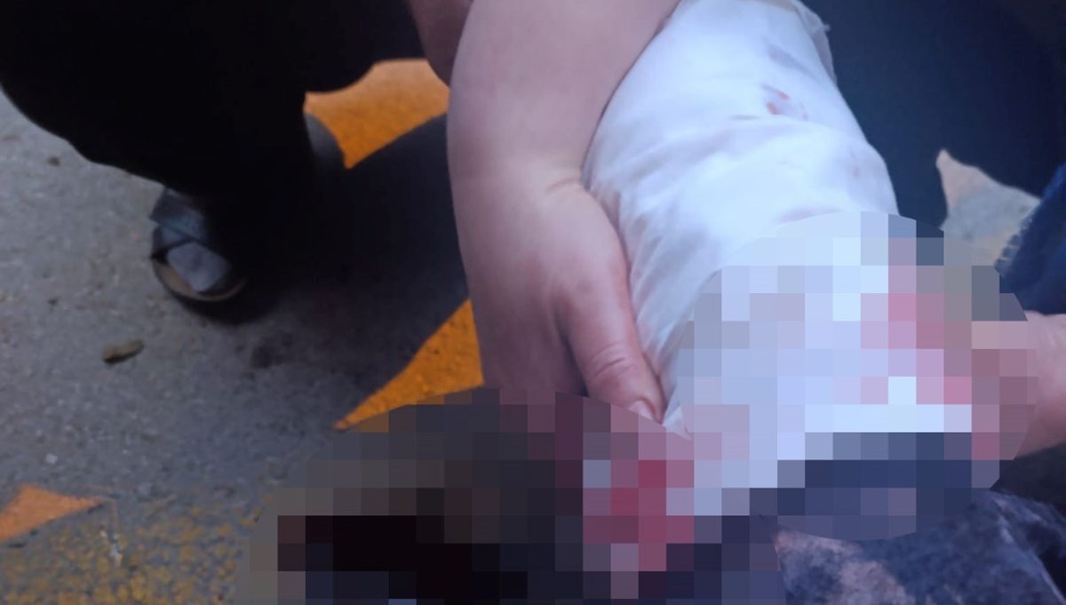 Ankara'da başıboş köpek dehşeti: Kadın akademisyenin bacakları ve yüzü parçalandı Ankara'da başıboş köpek dehşeti: Kadın akademisyenin bacakları ve yüzü parçalandı