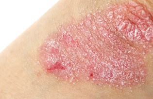 sedef hastaligi nasil tedavi edilir