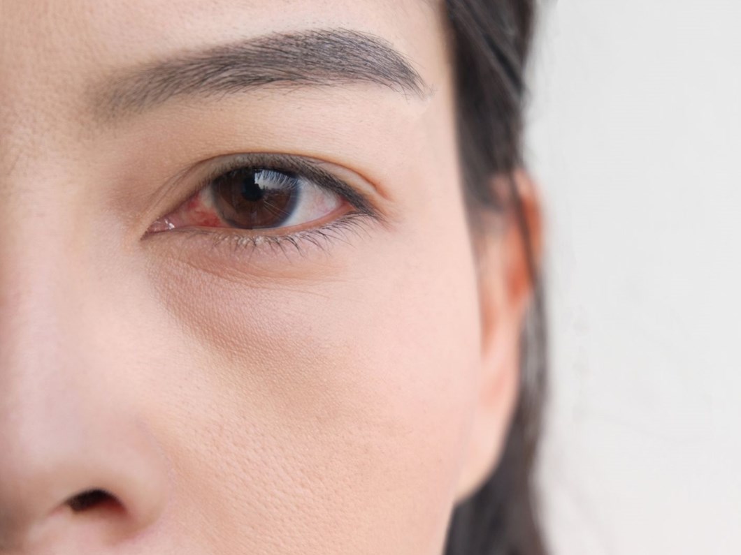 kirmizi goz corona virus belirtisi olabilir saglik haberleri ntv