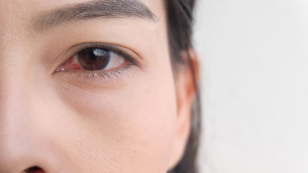 kirmizi goz corona virus belirtisi olabilir saglik haberleri ntv